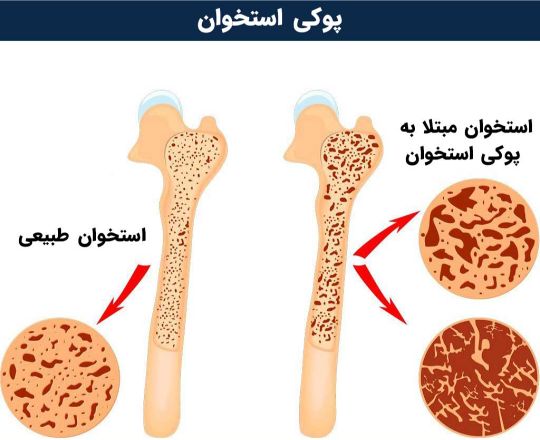 درمان ضعف و پوکی استخوان با طب اسلامی