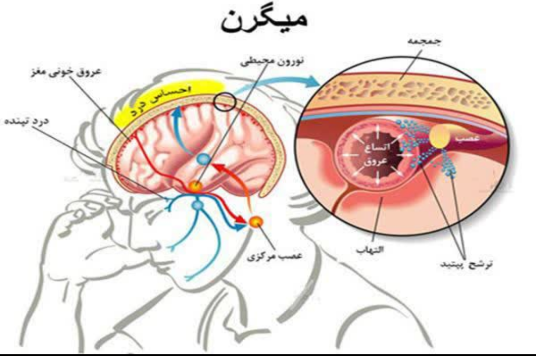 میگرن و زالو
