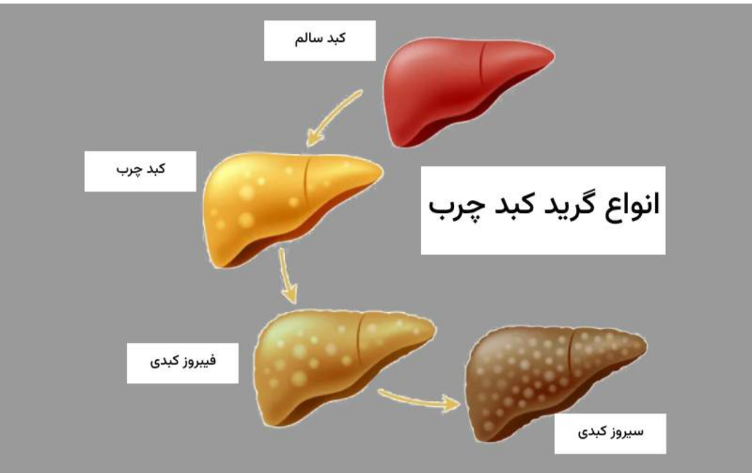 چگونه درگیر بیماری کبد چرب نشویم؟