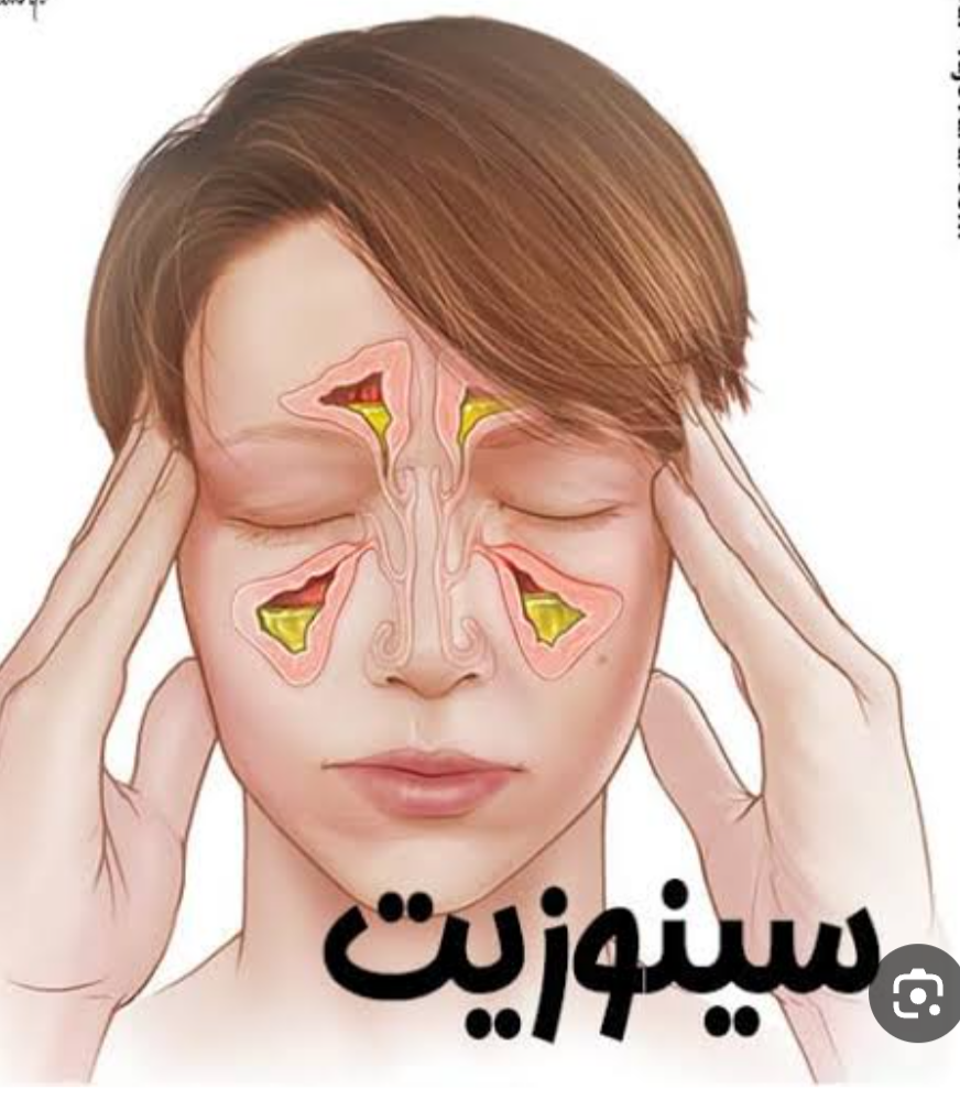 درمان سینوزیت با؟